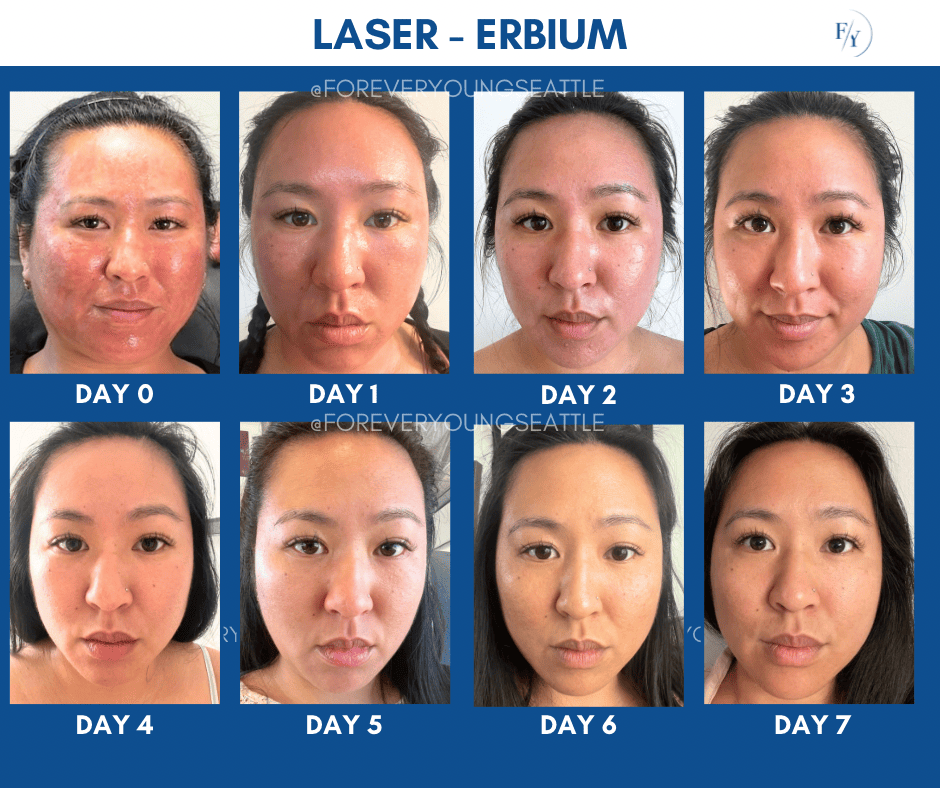 FILLER CHIN JEVEDERM FACIAL FILLER. FOREVER YOUNG AESTHETICS WEST SEATTLE
