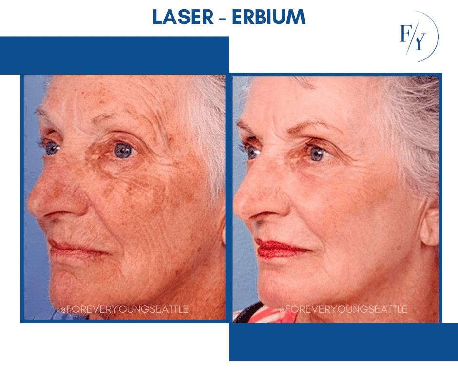 chin and jowel derma filler juviderm injections west seattle before and after