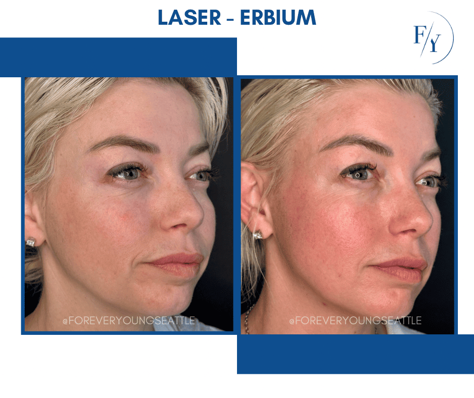 cheek and jowel derma filler juviderm injections west seattle before and after