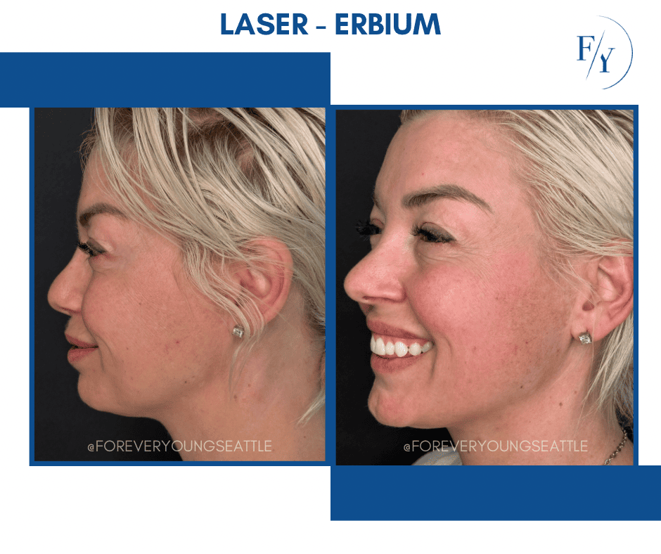 skin better facial products for anti-aging before and after. Only at Forever Young Aesthetics in West Seattle