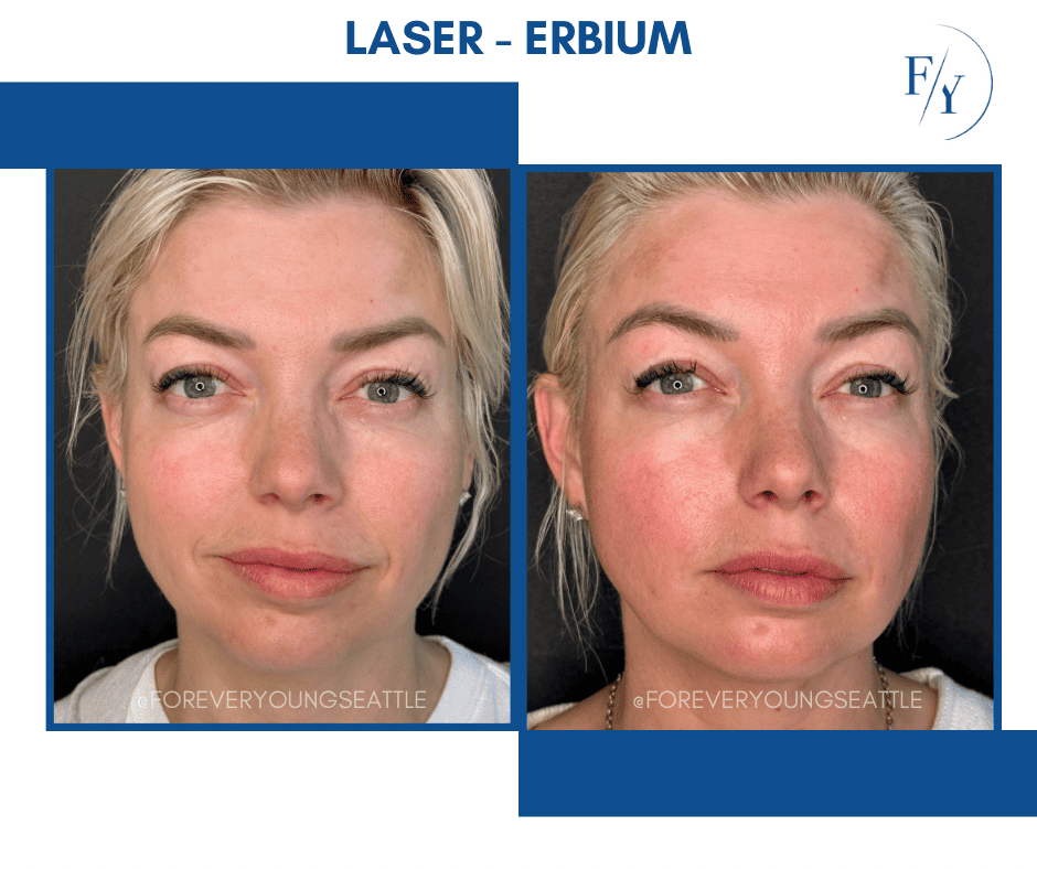 skin better facial products for anti-aging before and after. Only at Forever Young Aesthetics in West Seattle