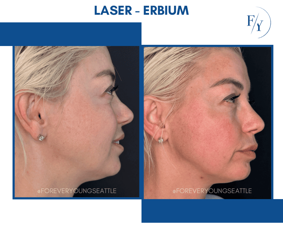 FILLER CHIN JEVEDERM FACIAL FILLER. FOREVER YOUNG AESTHETICS WEST SEATTLE