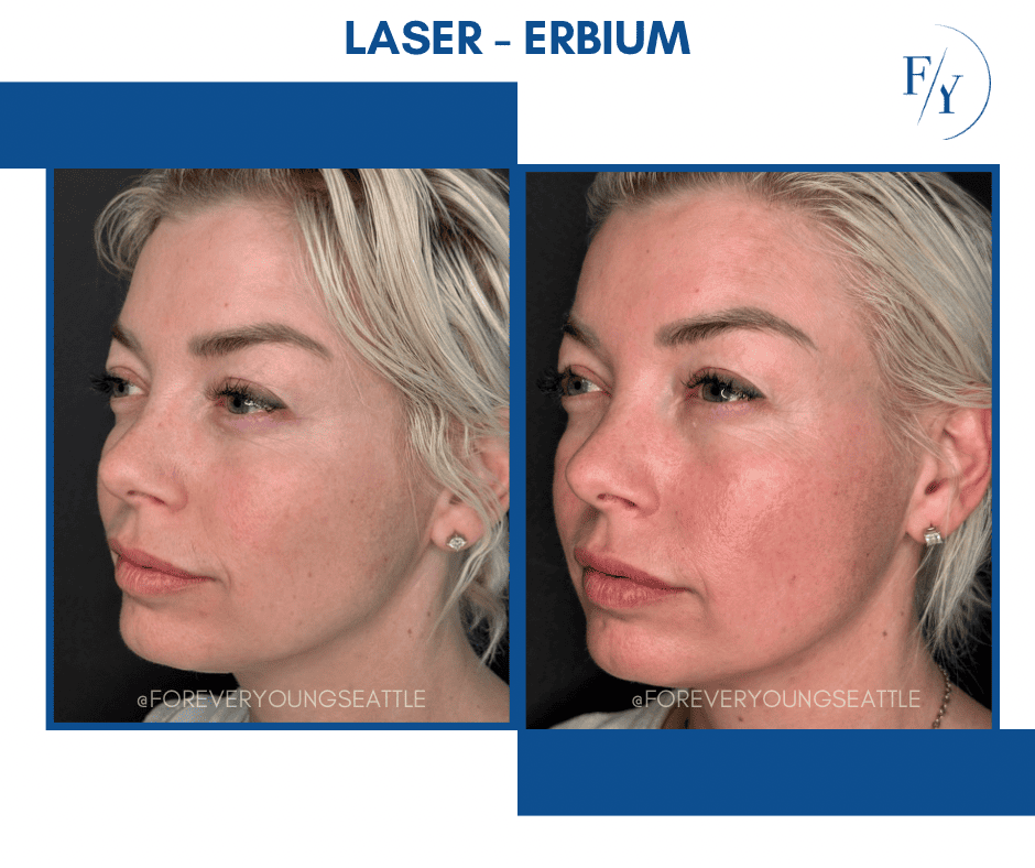 skin better facial products for anti-aging before and after. Only at Forever Young Aesthetics in West Seattle
