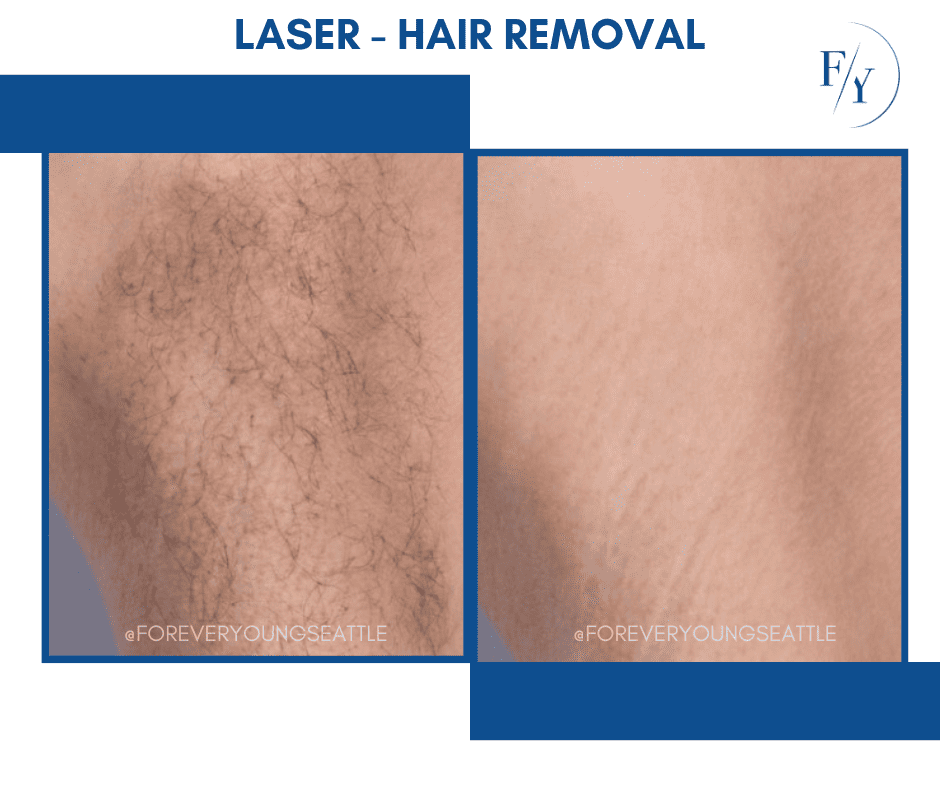 skin better facial products for anti-aging before and after. Only at Forever Young Aesthetics in West Seattle