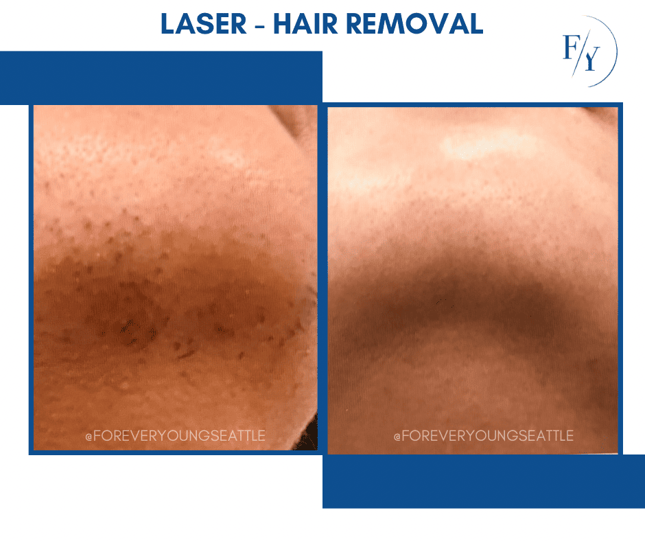 skin better facial products for anti-aging before and after. Only at Forever Young Aesthetics in West Seattle