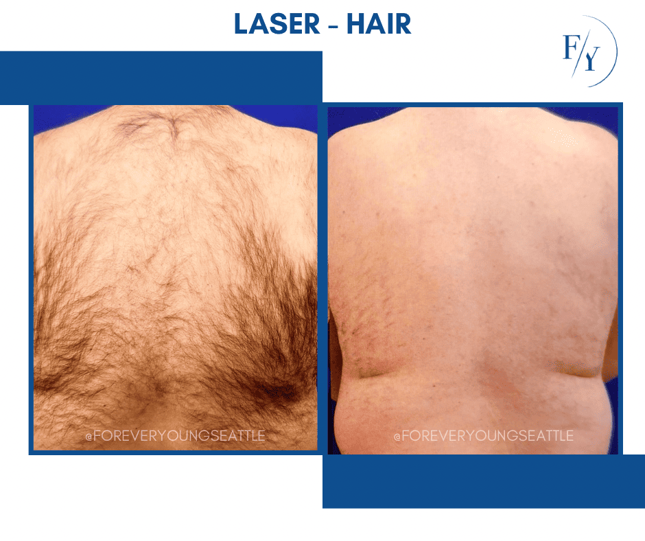 skin better facial products for anti-aging before and after. Only at Forever Young Aesthetics in West Seattle