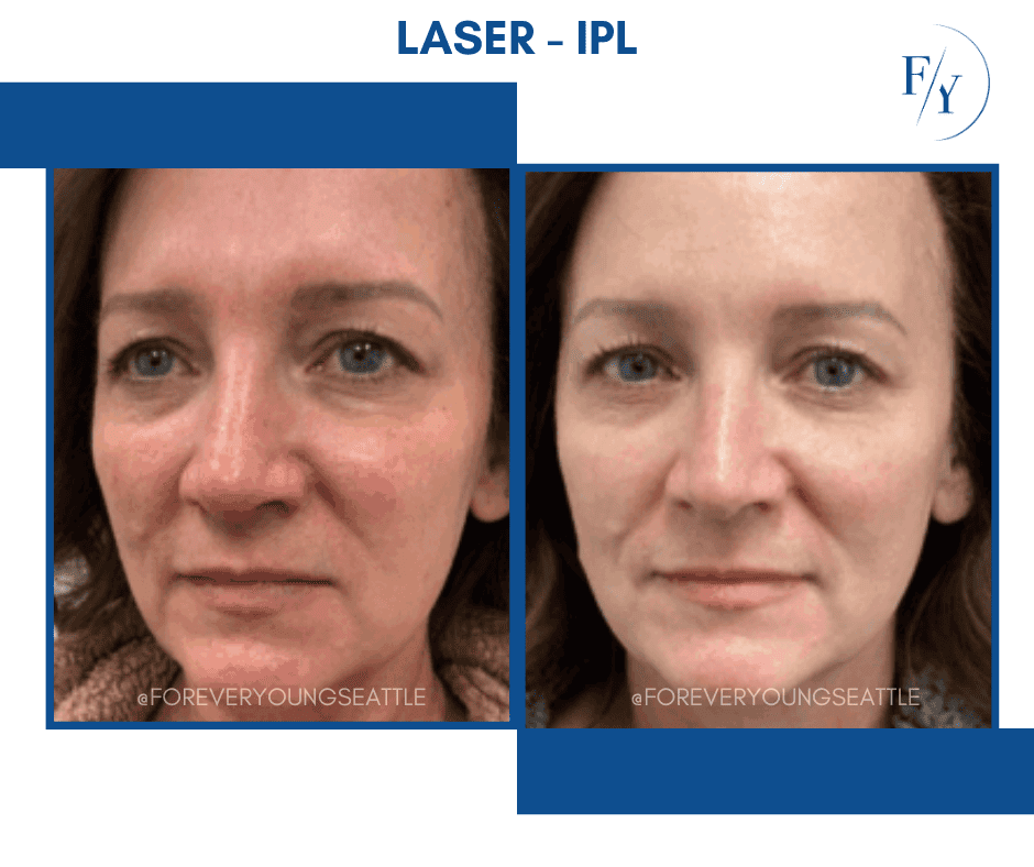 skin better facial products for anti-aging before and after. Only at Forever Young Aesthetics in West Seattle