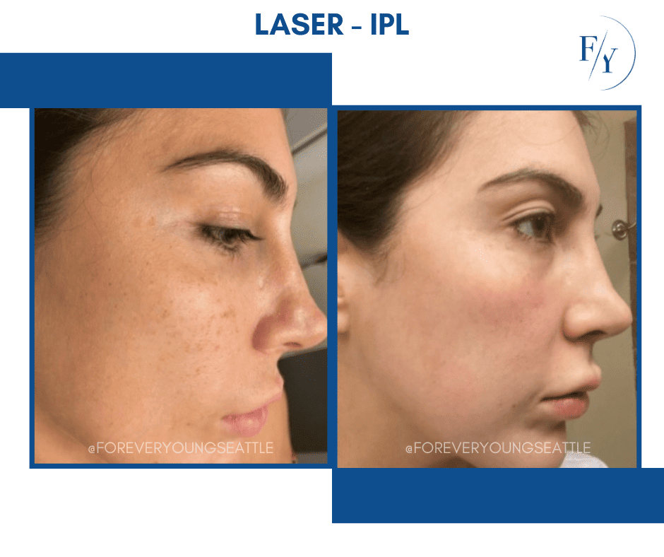 chin and jowel derma filler juviderm injections west seattle before and after