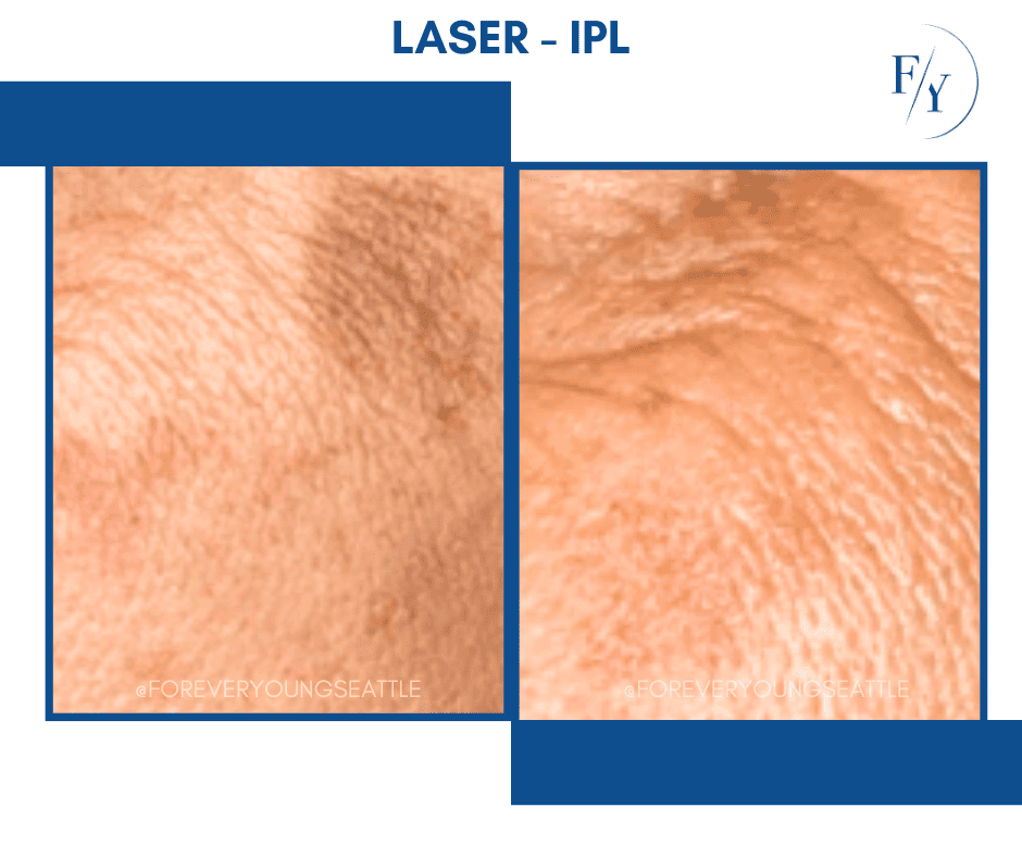 skin better facial products for anti-aging before and after. Only at Forever Young Aesthetics in West Seattle