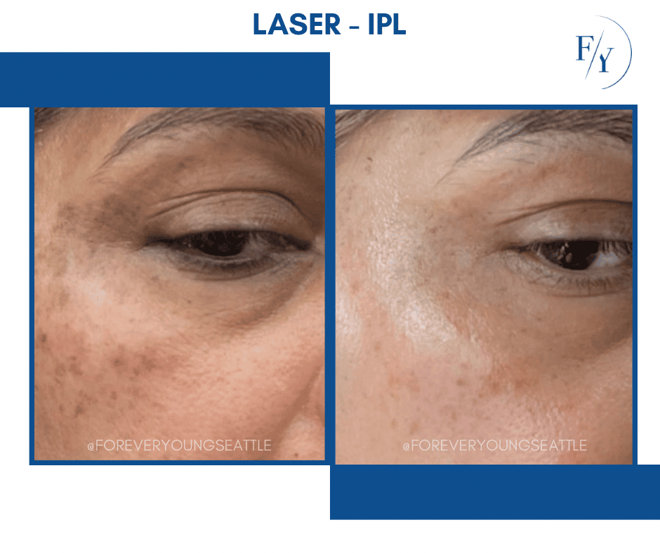 lip filler juviderm west seattle before and after