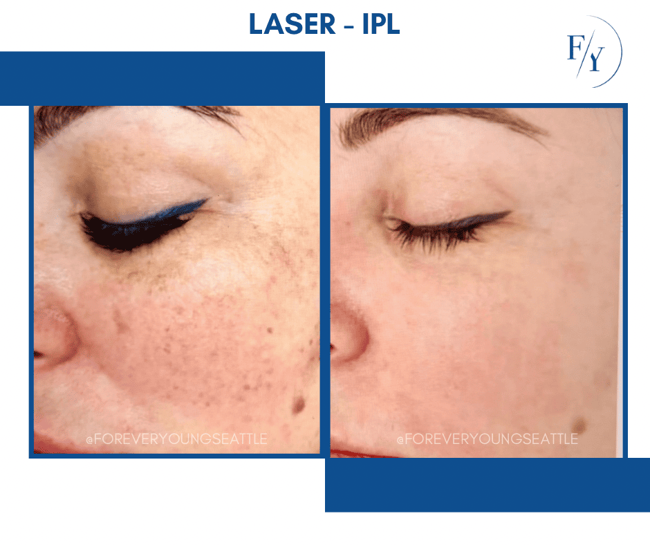 facial balancing cheek and jaw filler botox masseter injections west seattle before and after