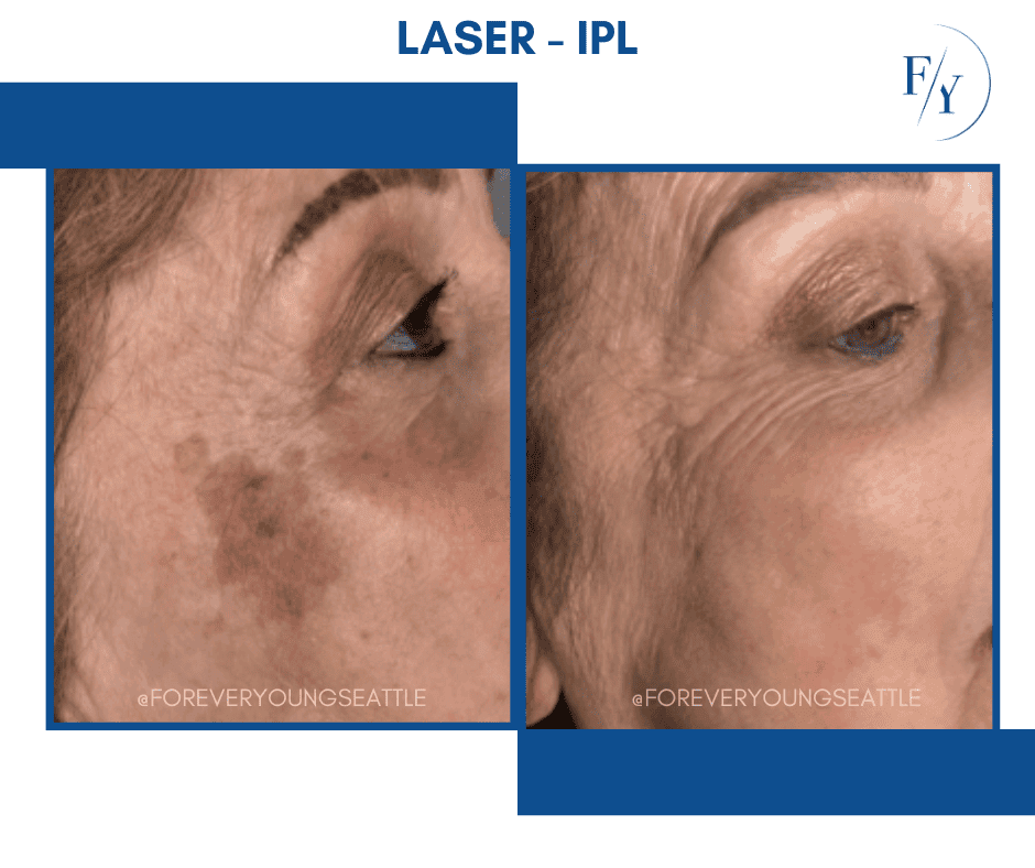 skin better facial products for anti-aging before and after. Only at Forever Young Aesthetics in West Seattle