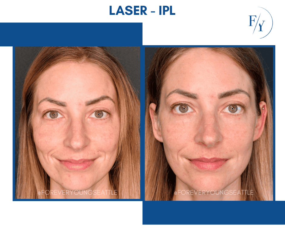 cheek and jowel derma filler juviderm injections west seattle before and after