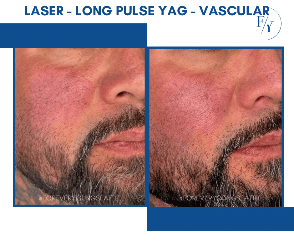 FILLER CHIN JEVEDERM FACIAL FILLER. FOREVER YOUNG AESTHETICS WEST SEATTLE