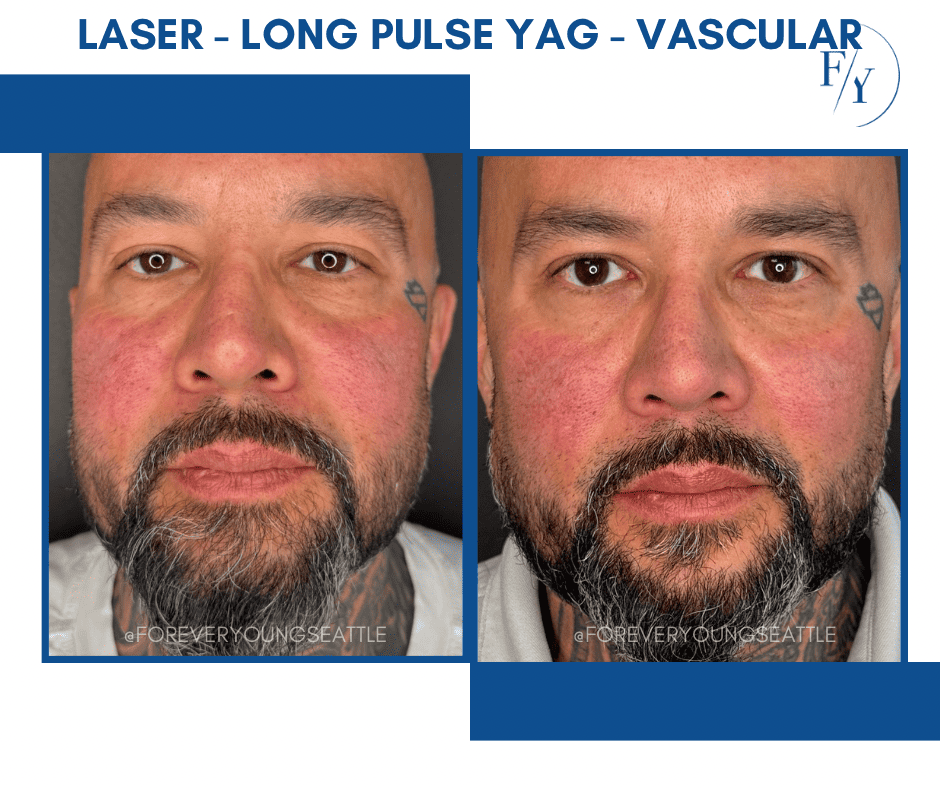 skin better facial products for anti-aging before and after. Only at Forever Young Aesthetics in West Seattle