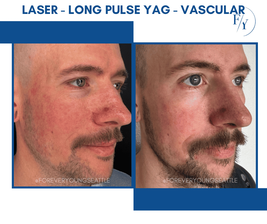 cheek and jowel derma filler juviderm injections west seattle before and after