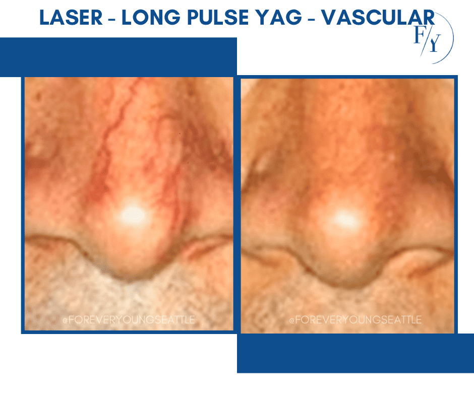 FILLER CHIN JEVEDERM FACIAL FILLER. FOREVER YOUNG AESTHETICS WEST SEATTLE
