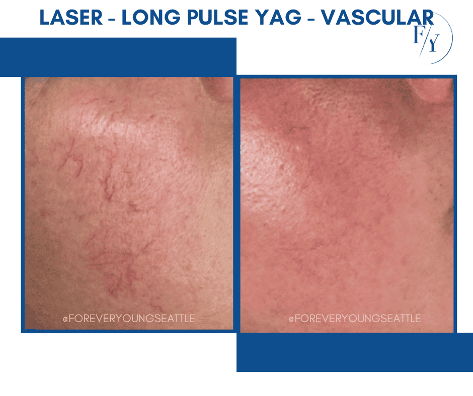 skin better facial products for anti-aging before and after. Only at Forever Young Aesthetics in West Seattle