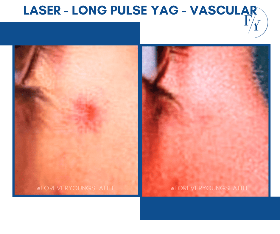 chin and jowel derma filler juviderm injections west seattle before and after