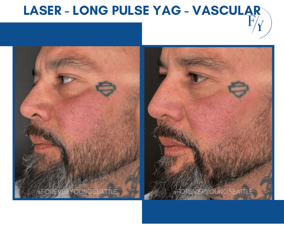 skin better facial products for anti-aging before and after. Only at Forever Young Aesthetics in West Seattle