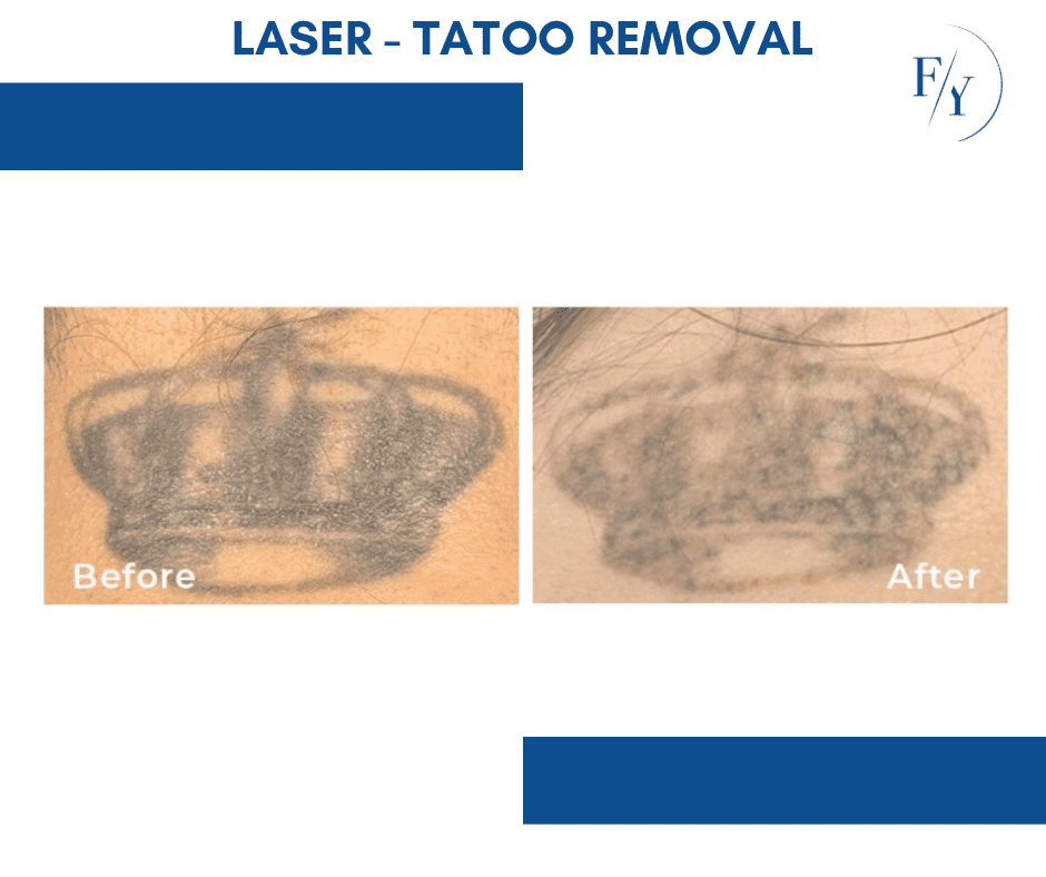 skin better facial products for anti-aging before and after. Only at Forever Young Aesthetics in West Seattle