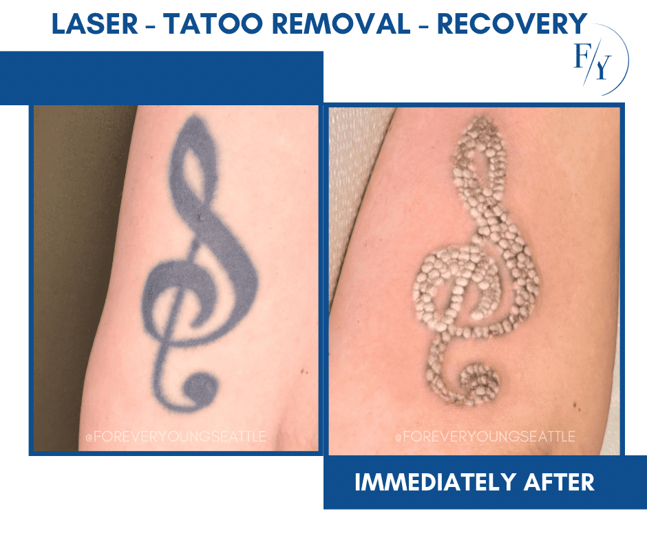 skin better facial products for anti-aging before and after. Only at Forever Young Aesthetics in West Seattle