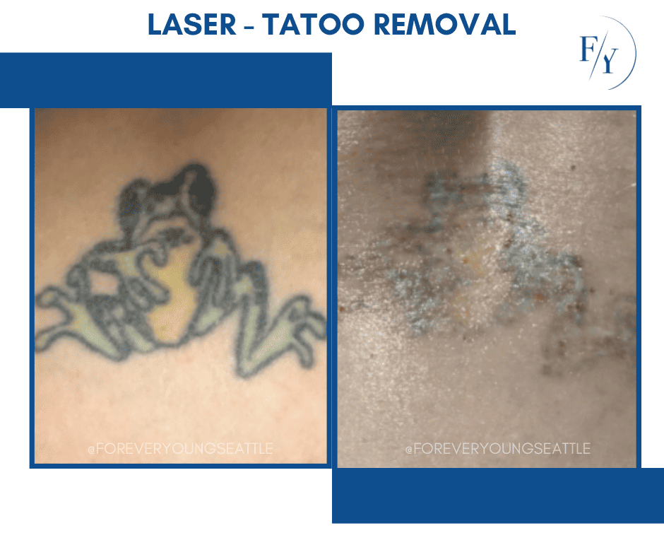 skin better facial products for anti-aging before and after. Only at Forever Young Aesthetics in West Seattle